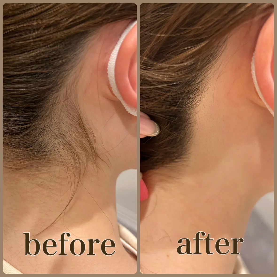 うなじケア(うなじ剃り＋脱毛) 